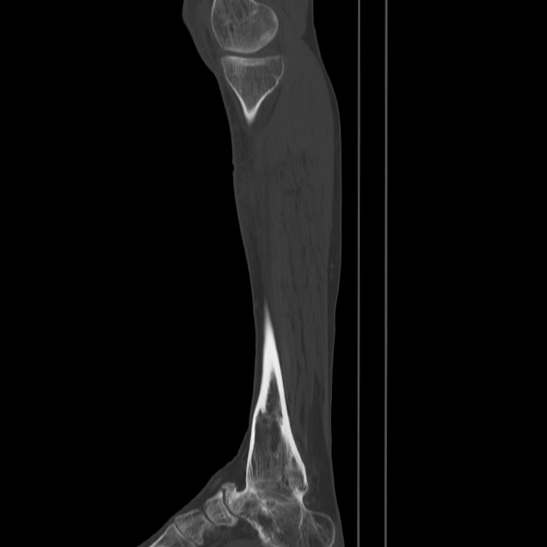 Brodie abscess - tibia (Radiopaedia 66028-75204 Sagittal bone window 14).jpg