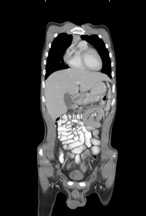 Bronchial carcinoid tumor (Radiopaedia 57187-64090 B 10).jpg