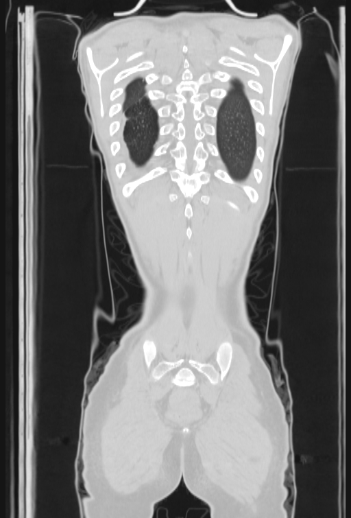 Bronchial carcinoid tumor (Radiopaedia 57187-64090 Coronal lung window 101).jpg
