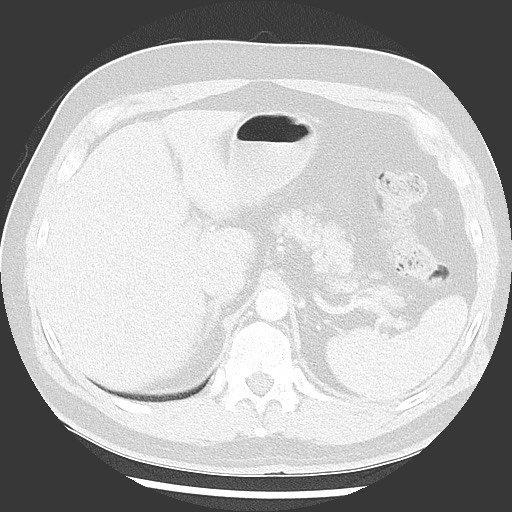 Bronchial carcinoid tumor (Radiopaedia 67377-76764 Axial lung window 60).jpg
