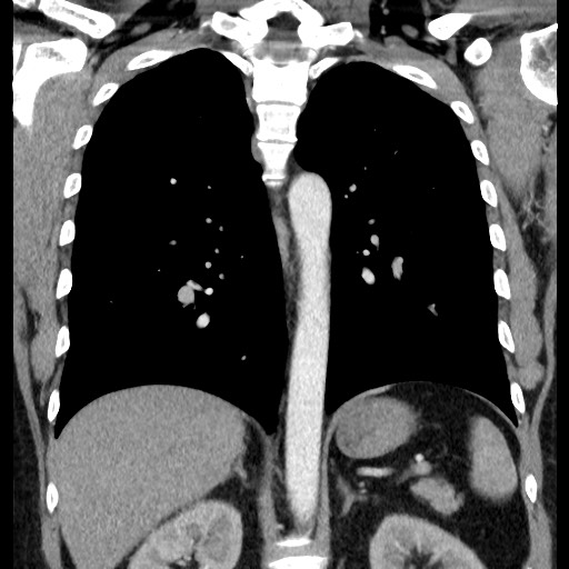 Bronchial carcinoid tumor (Radiopaedia 67377-76764 C 43).jpg