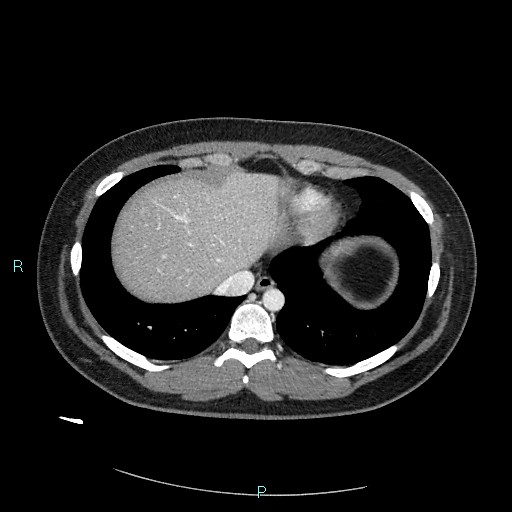 File:Bronchial carcinoid tumor (Radiopaedia 78272-90875 A 77).jpg