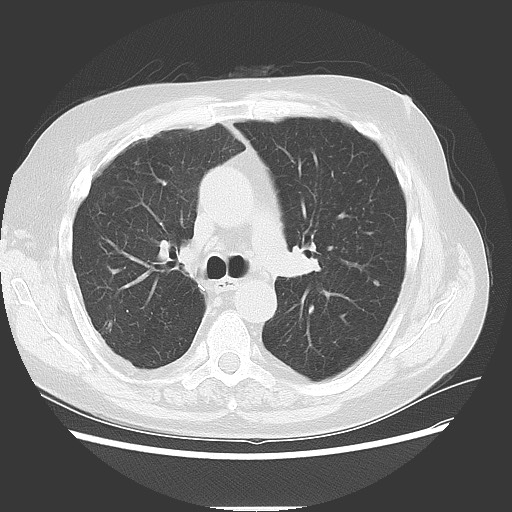 Bronchial stenosis - lung transplant (Radiopaedia 73133-83848 Axial lung window 26).jpg