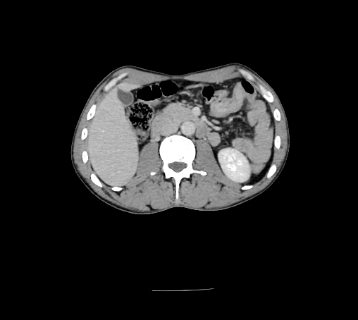 Bronchiectasis in Crohn disease (Radiopaedia 60311-67977 B 74).jpg