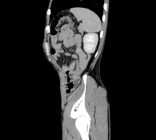 File:Bronchiectasis in Crohn disease (Radiopaedia 60311-67977 D 100).jpg