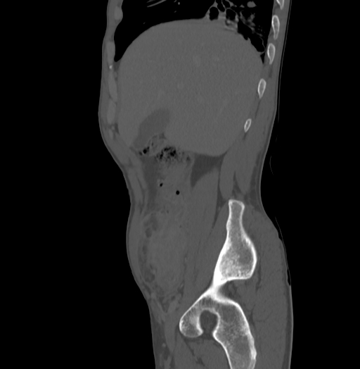 Bronchiectasis in Crohn disease (Radiopaedia 60311-67977 Sagittal bone window 45).jpg