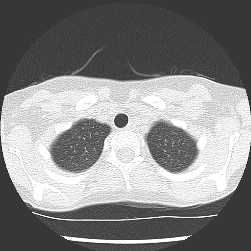 Bronchiolotis obliterans (Radiopaedia 73769-84575 Axial lung window 6).jpg