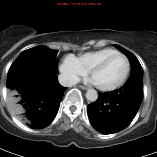 File:Bronchoalveolar carcinoma (BAC) (Radiopaedia 13436-13392 B 39).jpg