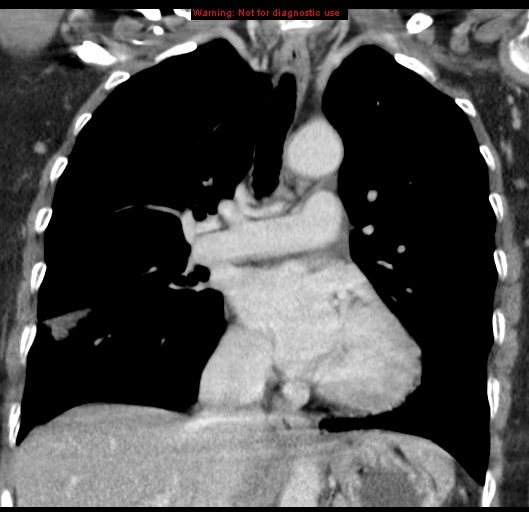 Bronchoalveolar carcinoma (BAC) (Radiopaedia 13436-13392 E 28).jpg