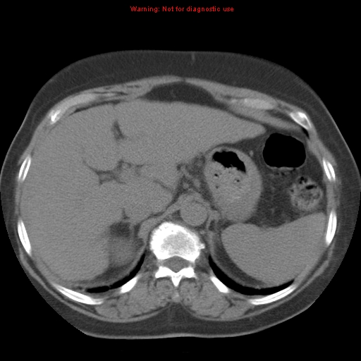 Bronchoalveolar carcinoma (Radiopaedia 13224-13233 Axial non-contrast 47).jpg