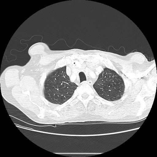 File:Bronchocele (Radiopaedia 17097-16795 Axial lung window 21).jpg