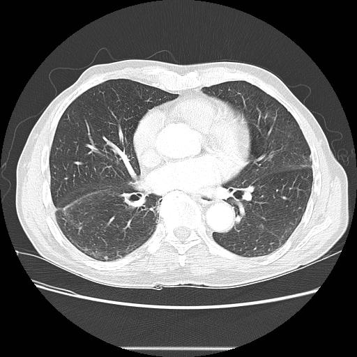 Bronchocele (Radiopaedia 17097-16795 Axial lung window 69).jpg