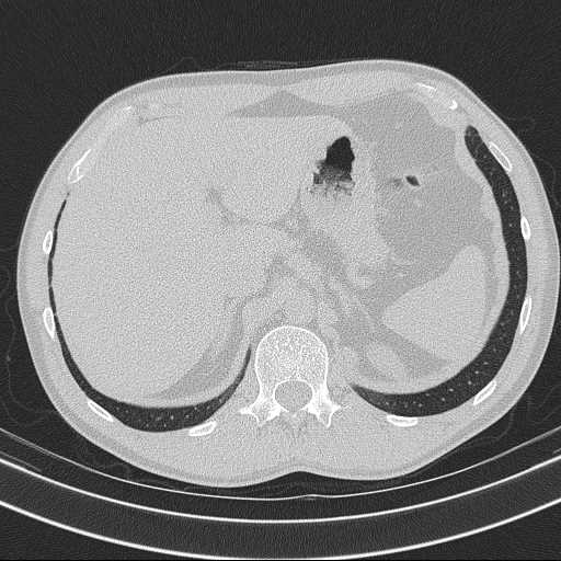 Bronchocele (Radiopaedia 60676-68429 Axial lung window 70).jpg
