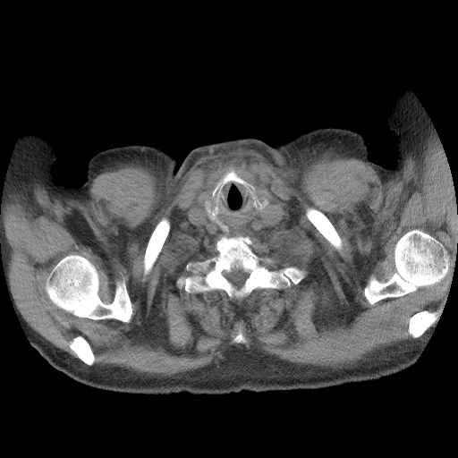 File:Bronchogenic carcinoma with metastatic lymphadenopathy (Radiopaedia 37671-39569 Axial non-contrast 1).jpg