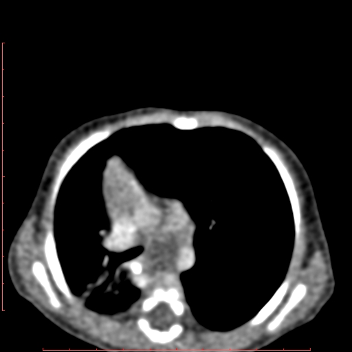 Bronchogenic cyst (Radiopaedia 78599-91409 B 90).jpg