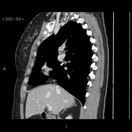 File:Bronchogenic cyst - posterior mediastinal (Radiopaedia 43885-47364 B 35).jpg