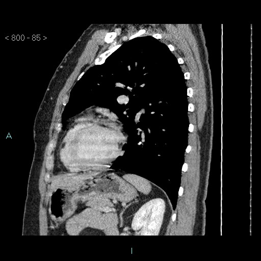 File:Bronchogenic cyst - posterior mediastinal (Radiopaedia 43885-47364 B 56).jpg