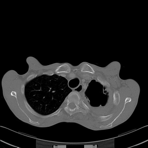 File:Bronchopleural fistula secondary to tuberculosis (Radiopaedia 20415-20322 Axial bone window 7).jpg
