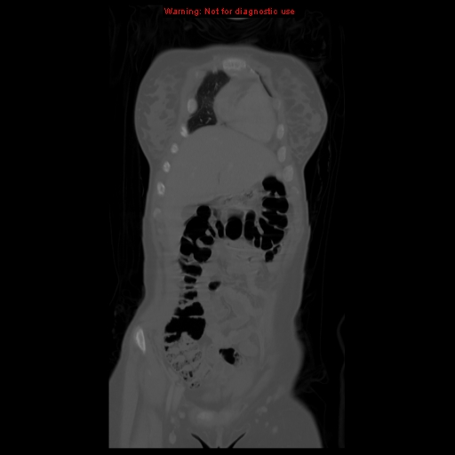 File:Brown tumor (Radiopaedia 12318-12596 D 18).jpg