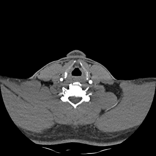 Buccal fat pad arteriovenous malformation (Radiopaedia 70936-81144 D 101).jpg