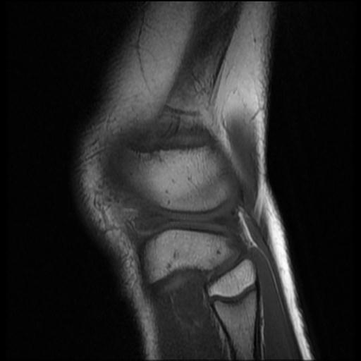 File:Bucket handle tear - lateral meniscus (Radiopaedia 72124-82634 Sagittal T1 2).jpg