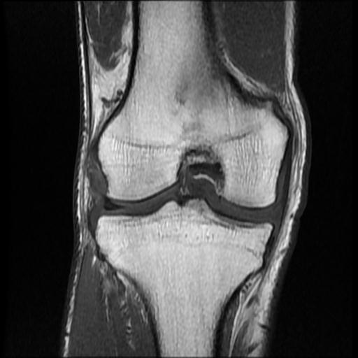File:Bucket handle tear - medial meniscus (Radiopaedia 69245-79026 Coronal T1 12).jpg