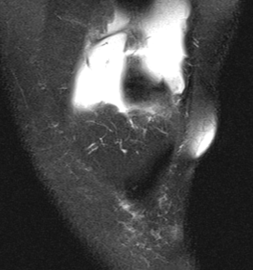 File:Bucket handle tear - medial meniscus (Radiopaedia 79028-91942 Coronal PD fat sat 20).jpg