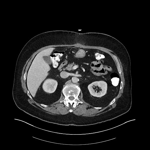 Buried bumper syndrome - gastrostomy tube (Radiopaedia 63843-72575 A 23).jpg