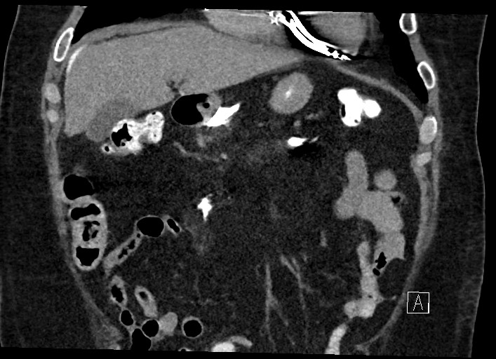 Buried bumper syndrome - gastrostomy tube (Radiopaedia 63843-72577 Coronal Inject 45).jpg