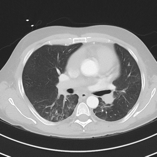 Burkitt lymphoma (Radiopaedia 34686-36121 Axial lung window 24).png