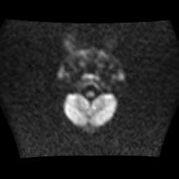 File:Burkitt lymphoma of the orbit- pre and post chemotherapy (Radiopaedia 31214-31930 Axial DWI 3).jpg