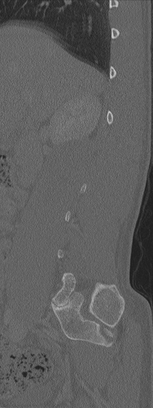 Burst fracture - T12 with conus compression (Radiopaedia 56825-63647 Sagittal bone window 70).png