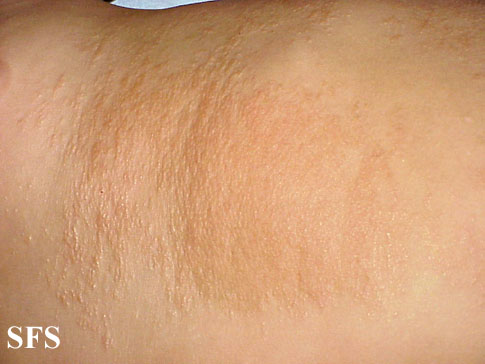 Buschke-Ollendorf Syndrome (Dermatology Atlas 4).jpg