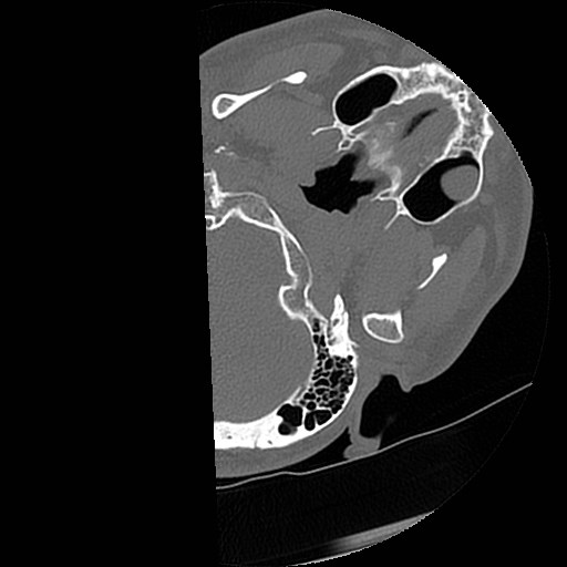 C1-C2 "subluxation" - normal cervical anatomy at maximum head rotation (Radiopaedia 42483-45607 Axial non-contrast 70).jpg