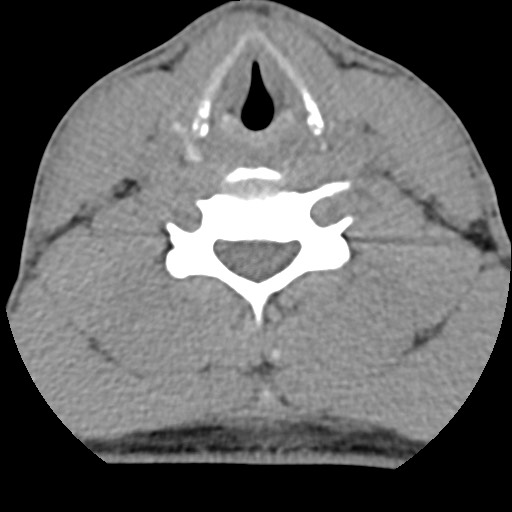 File:C5 facet fracture (Radiopaedia 58374-65499 Axial non-contrast 60).jpg