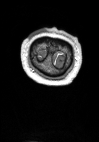 CNS cryptococcosis (Radiopaedia 70895-81108 Coronal T1 C+ 188).jpg