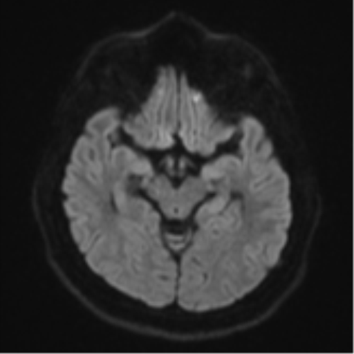 File:CNS vasculitis (Radiopaedia 55715-62263 Axial DWI 41).png