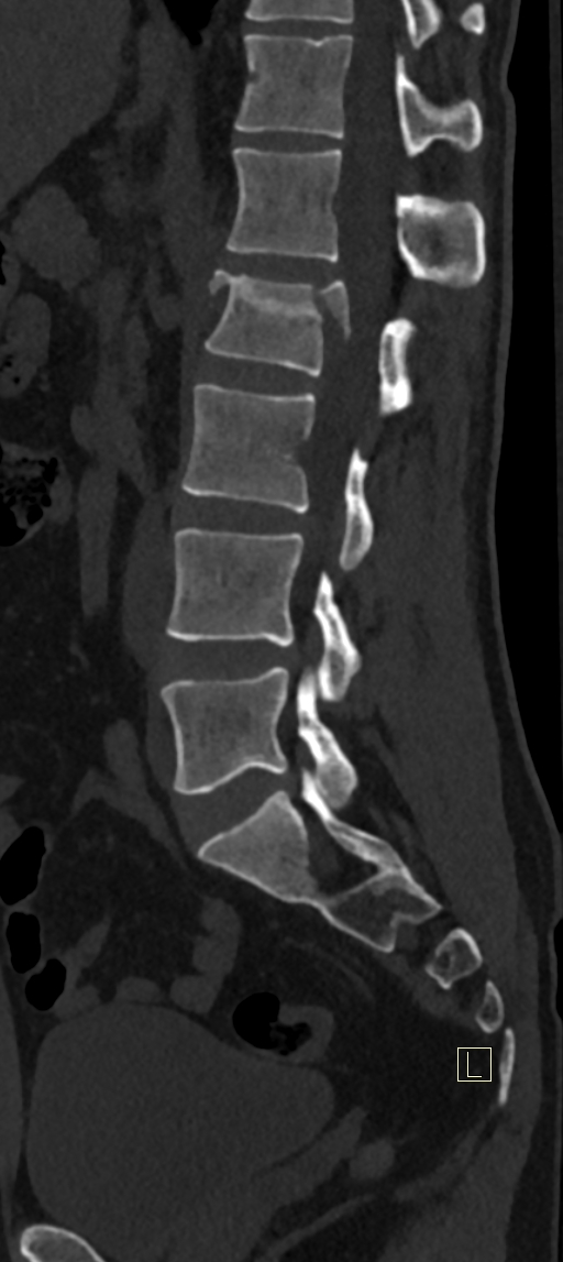Calcaneal fractures with associated L2 burst fracture (Radiopaedia 71671-82493 Sagittal bone window 34).jpg