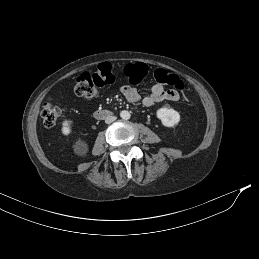 Calcified adrenal glands and Spigelian hernia (Radiopaedia 49741-54988 A 119).jpg