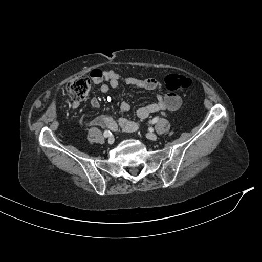 Calcified adrenal glands and Spigelian hernia (Radiopaedia 49741-54988 A 164).jpg