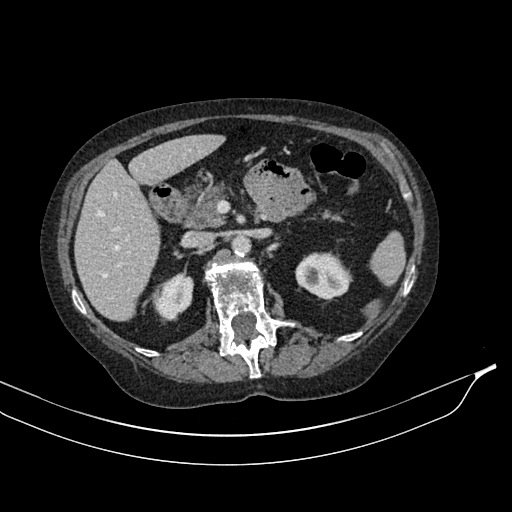 Calcified adrenal glands and Spigelian hernia (Radiopaedia 49741-54988 A 72).jpg