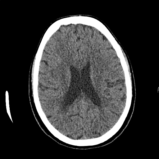 Calcified cerebral hydatid cyst (Radiopaedia 65603-74717 Axial non-contrast 46).jpg