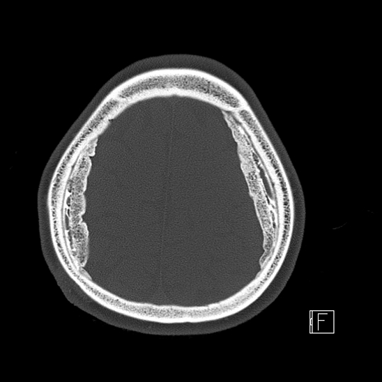 Calcified chronic subdural hematoma (Radiopaedia 77374-89492 Axial bone window 111).jpg