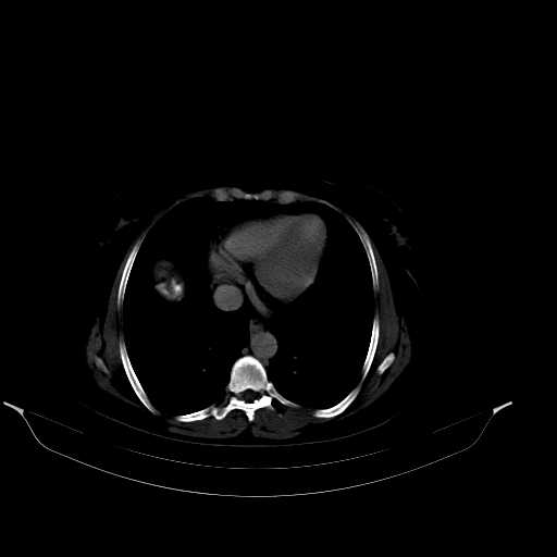 File:Calcified hydatid cyst of the liver (Radiopaedia 21212-21112 Axial bone window 7).jpg
