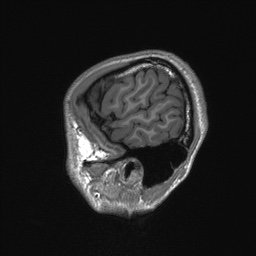 Callosal dysgenesis with interhemispheric cyst (Radiopaedia 53355-59335 Sagittal T1 22).jpg