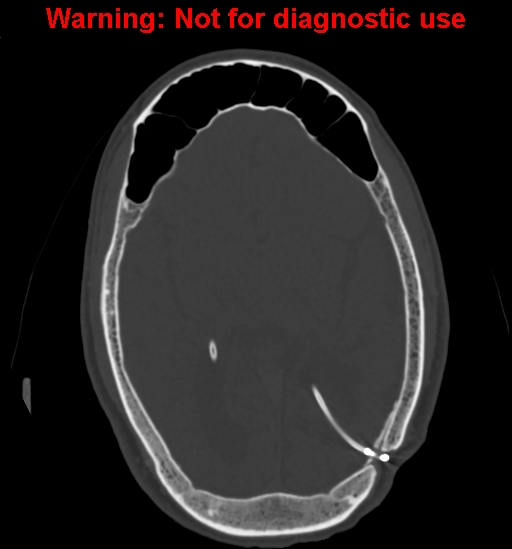 Calvarial thickening from chronic shunting (Radiopaedia 60079-67637 Axial bone window 93).jpg
