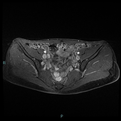 File:Canal of Nuck cyst (Radiopaedia 55074-61448 Axial T1 C+ fat sat 20).jpg
