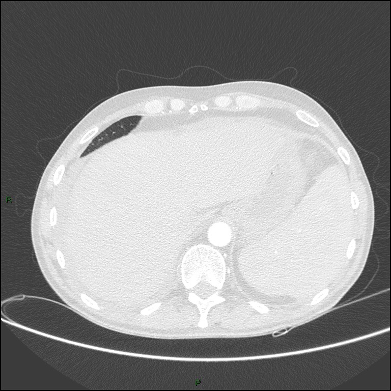 Cannonball metastases (Radiopaedia 82110-96150 Axial lung window 168).jpg