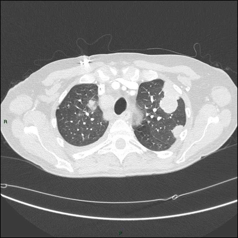 Cannonball metastases (Radiopaedia 82110-96150 Axial lung window 53).jpg