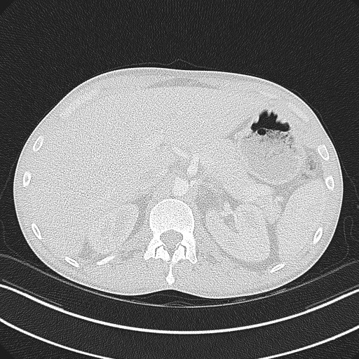 File:Cannonball metastases - testicular choriocarcinoma (Radiopaedia 84510-99891 Axial lung window 97).jpg